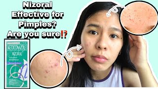 Nizoral ketoconazole honest review  Dandruff shampoo for fungal acne [upl. by Arel]