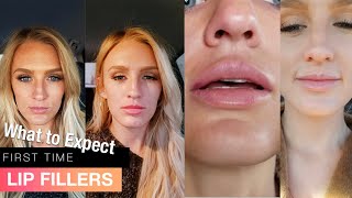 My first time getting LIP FILLERS before AND after  1 syringe Juvederm Ultra [upl. by Shanda]