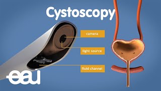 Cystoscopy overactive bladder [upl. by Cud]