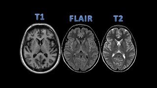 MRI t1 vs t2 [upl. by Gardener]