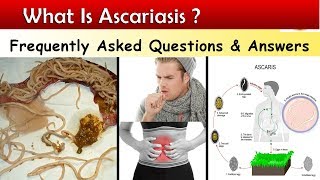 What is Ascariasis   Ascaris Lumbricoids Infections  FAQ [upl. by Rosenblum139]