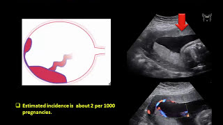 Fetal Circulation in Hindi हिन्दी  Embryology  Nursing Lecture [upl. by Bashee279]