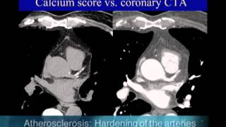 UCSF Radiology Calcium Scoring vs Coronary CTA Scan [upl. by Arinay]