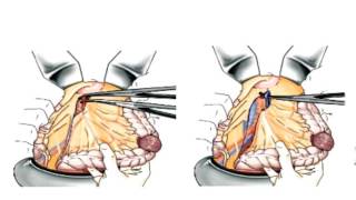 Chirurgie des cancers colorectaux [upl. by Ear]