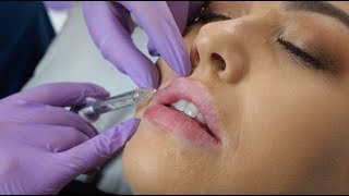 Lip Fillers  what to expect during the procedure  The Laser amp Skin Clinic [upl. by Aerua8]