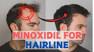 Minoxidil for Frontal Baldness  Restore Your Hairline [upl. by Gitel758]