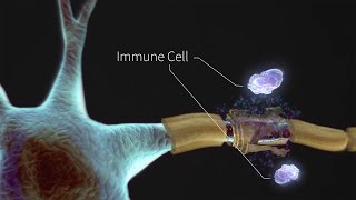 What is Multiple Sclerosis [upl. by Ielak302]