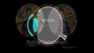 Retinal Detachment [upl. by Button]