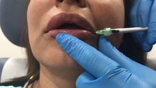 Reversing poorly placed lip filler using Hylenex hyaluronidase [upl. by Orlan]