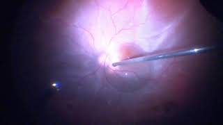 Surgery Vitrectomy for Retinal Detachment Assortment of Cases [upl. by Rhiana]