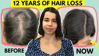 My Hair Loss Routine  Do Minoxidil and Spironolactone Work  Female Hair Loss [upl. by Aubine343]