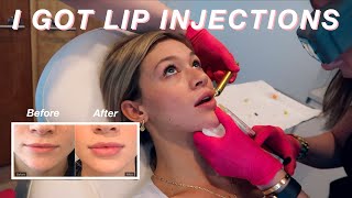 I GOT LIP INJECTIONS  My Lip Filler Experience  Before During  After [upl. by Akehs]