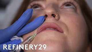 I Got Lip Filler Injections For The First Time  Macro Beauty  Refinery29 [upl. by Tenaej404]