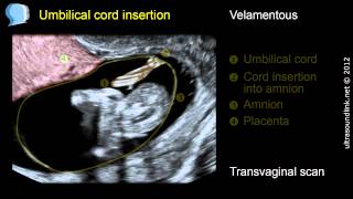 Velamentous insertion of the umbilical cord [upl. by Rasaec]