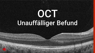 OCT  Unauffälliger Befund [upl. by Premer]