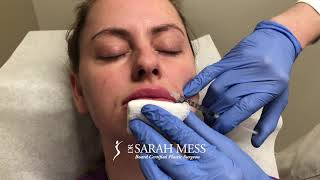 Lip Filler with Insulin Syringe by Dr Sarah Mess [upl. by Orran]