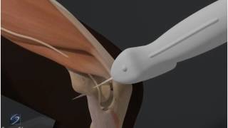 How To Elbow Ulnar Nerve 3D Video [upl. by Melar]