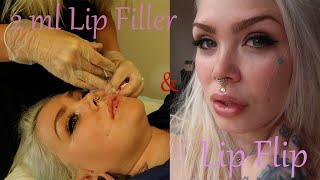 2ml Lip Filler And Lip Flip [upl. by Beckie495]