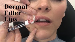 Dermal Filler Lips  1 Syringe RESTYLANE [upl. by Yehsa]