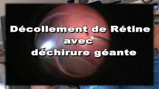 Opération de décollement rétine avec déchirure géante supérieure Dr PierreAndré DUVAL [upl. by Sibylla]