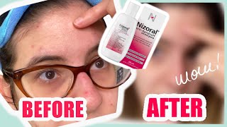 Nizoral Shampoo Against Fungal Acne  Is it Effective [upl. by Eedak]