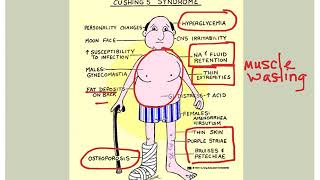 Endocrine Disorders [upl. by Madelene57]