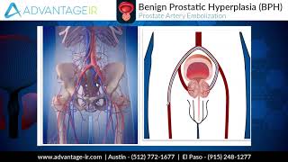 Prostate Artery Embolization PAE Explained [upl. by Comethuauc]