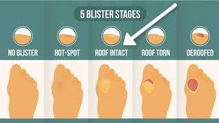 How To Treat A Blister Correctly First Look At Your Blister Roof [upl. by Ahsetan]