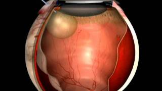 le décollement de la rétine  evrs [upl. by Trometer]