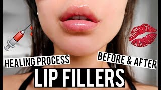 LIP FILLERS BEFORE AND AFTER amp HEALING PROCESS VLOG  KatesBeautyStation [upl. by Zora283]