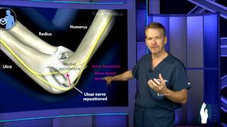 Cubital Tunnel Surgery [upl. by Mcdade]