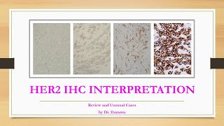 HER2 IHC Interpretation Guide Examples and Challenging Scenarios [upl. by Cybill]