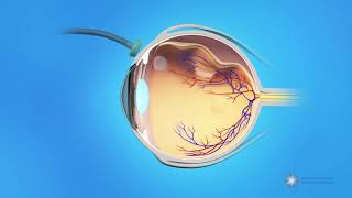 Vitrectomy Surgery for Detached Retina [upl. by Locke759]